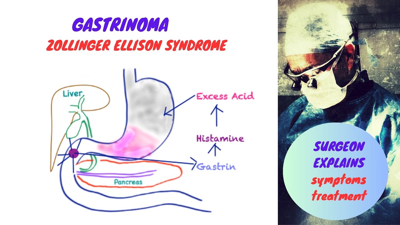 Gastrinoma | Zollinger Ellison Syndrome