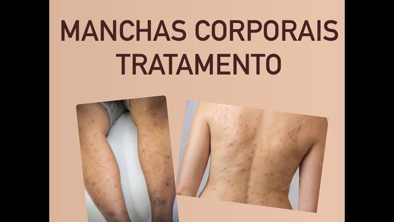 Manchas Corporais frequentes após lesões de pele ou machucados
