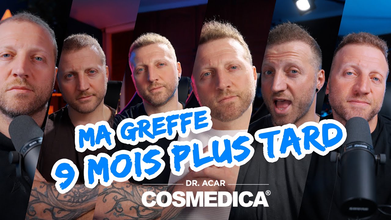 UPDATE 9 MOIS : Ma GREFFE DE CHEVEUX neuf mois plus tard! - CLINIQUE COSMEDICA
