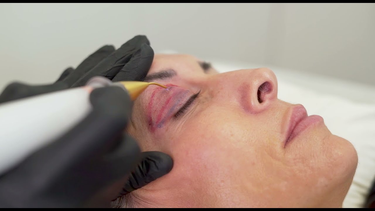 Jett Plasma Lift - Técnica de barrido - Dra. Romina Barzena