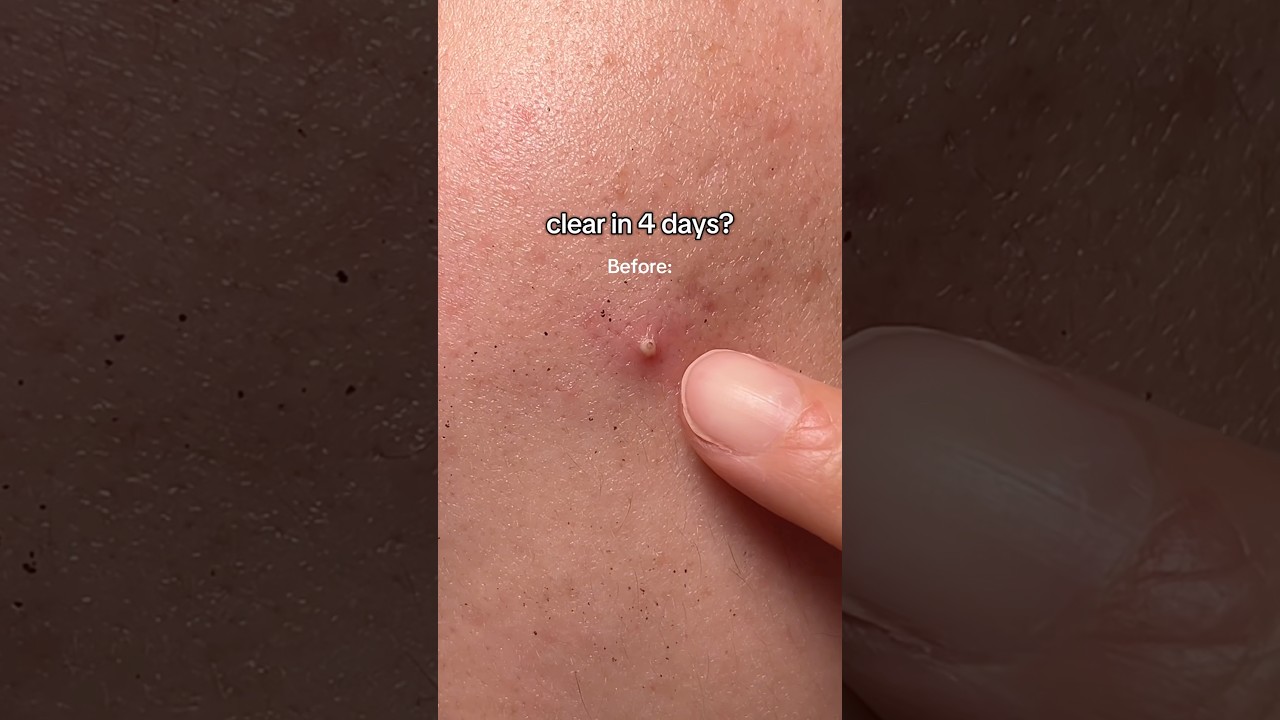 Acne does not stand a chance against dr.althea 345 relief 🤍