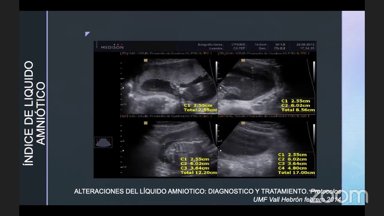 Fisiología y Alteraciones del Liquido Amniotico