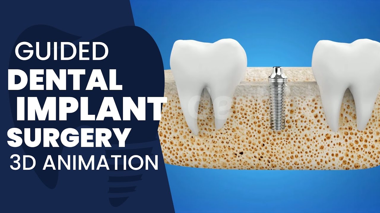 Dentfix | Guided Dental Implant Surgery 3D Animation