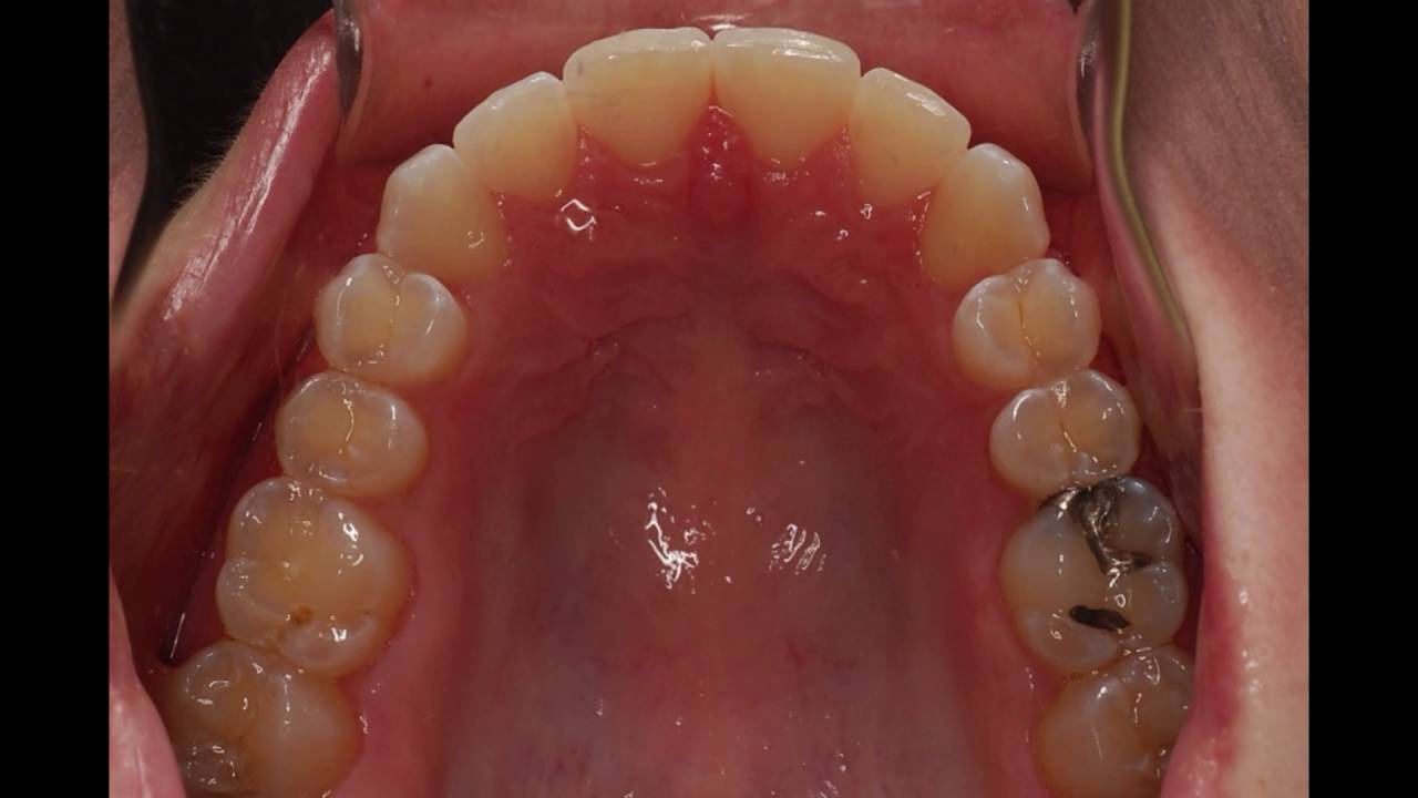 Invisalign Patients Before and After 2000 -2016: Nirenblatt Orthodontics