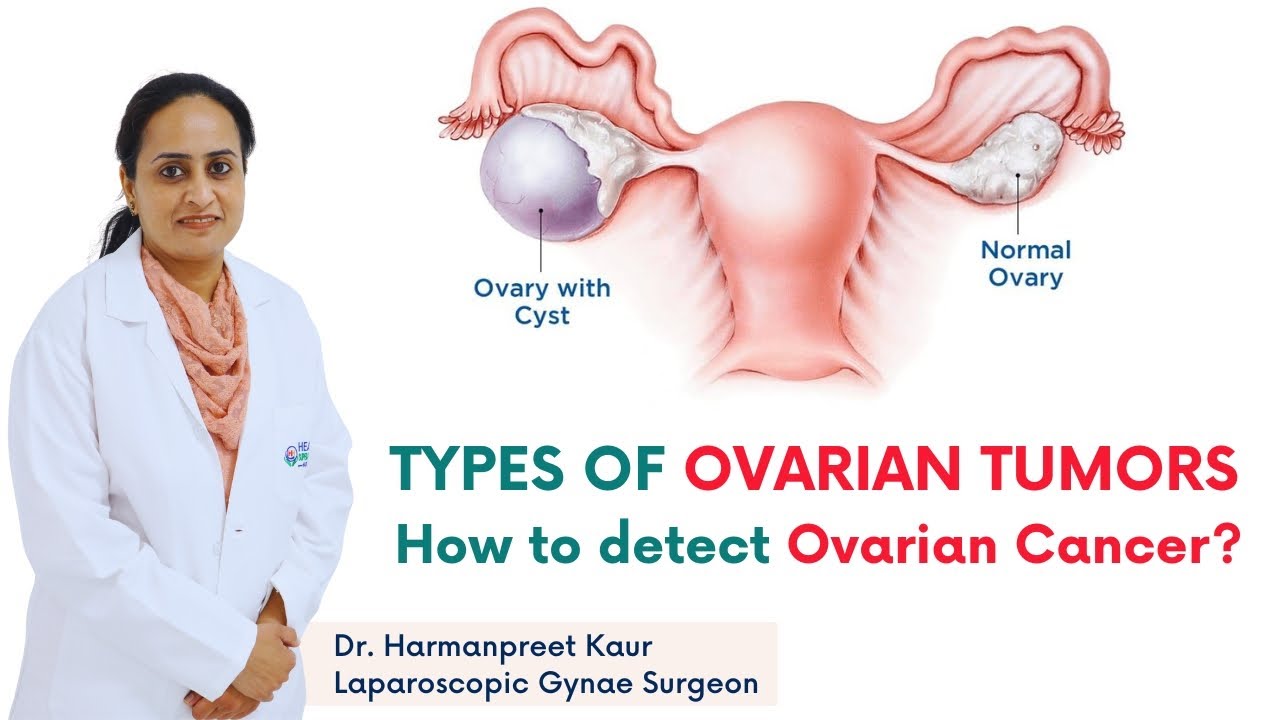 Types of ovarian tumors in Hindi  | How to detect Ovarian Cancer | Healing Hospital Chandigarh