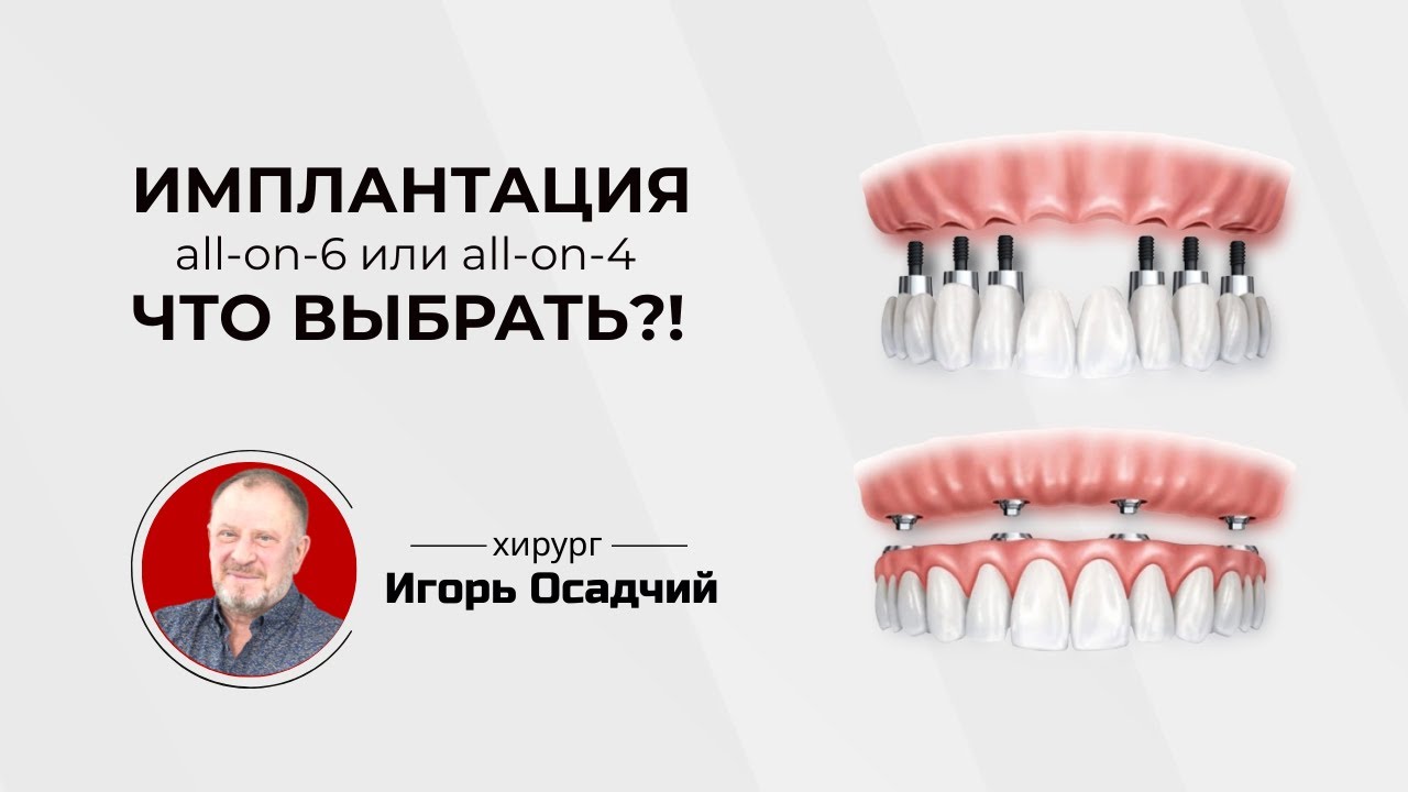 Имплантация Все-на-4 и Все-на-6, что выбрать?