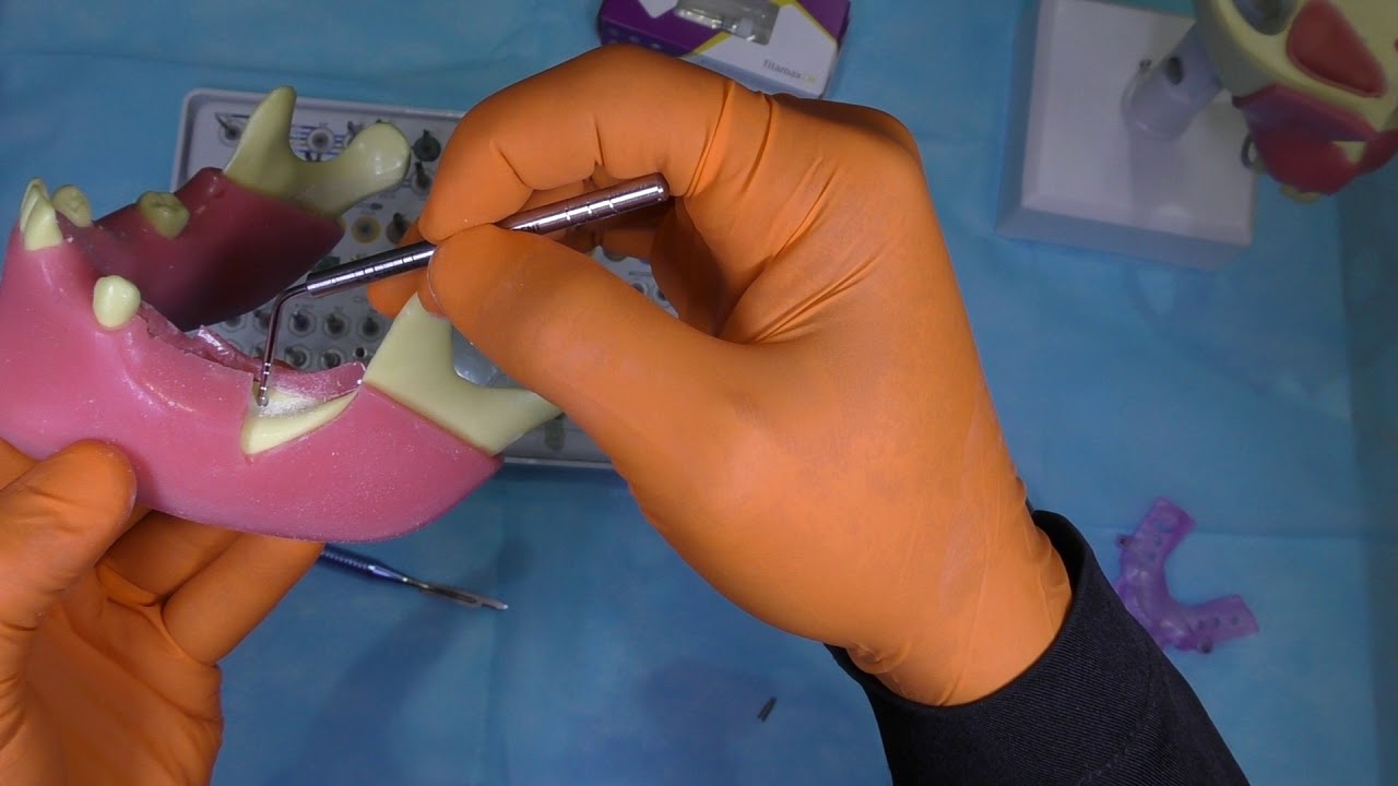 Fresagem - Implante 3.5mm