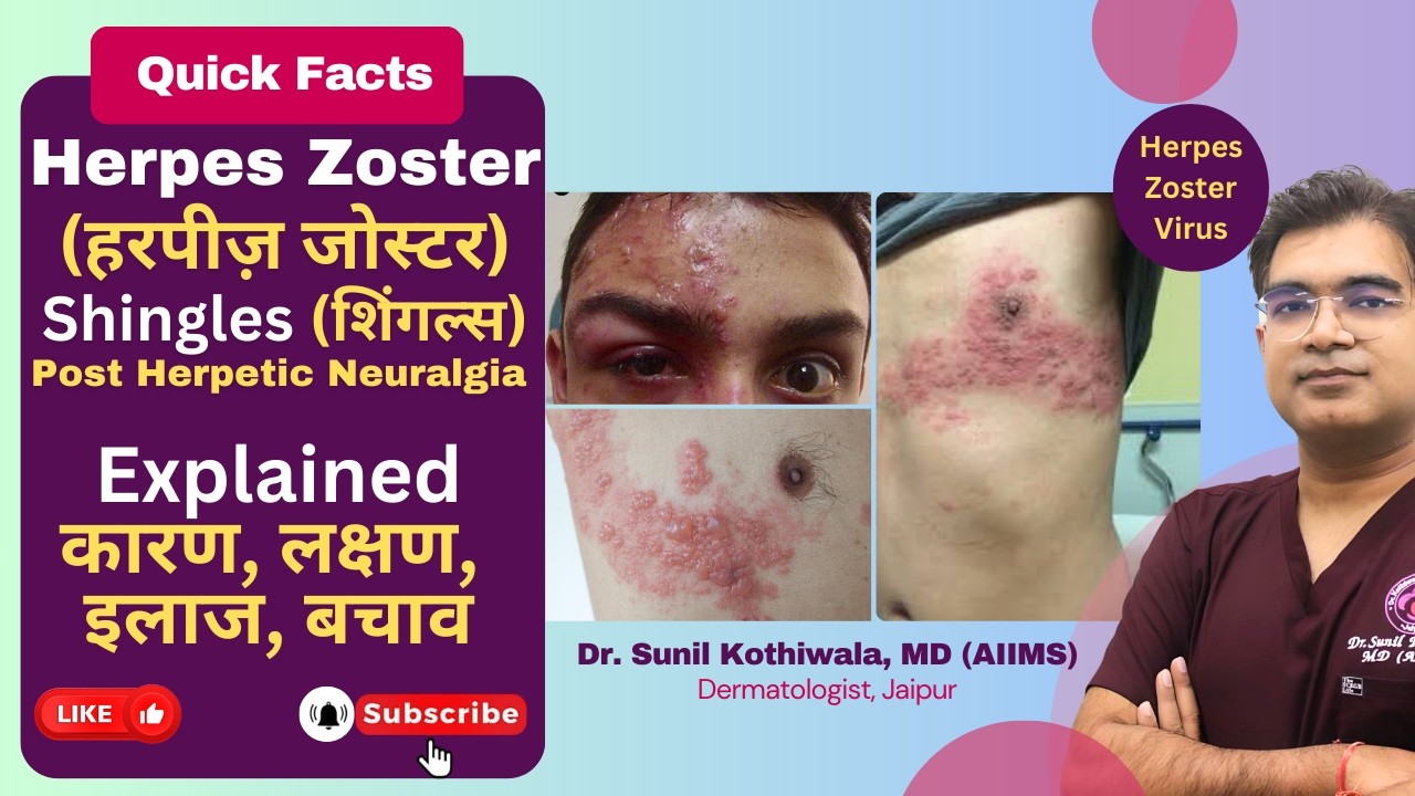 Herpes Zoster (Shingles) Virus Treatment | हर्पीज़ जोस्टर (शिंगल्स) क्यों होता है, लक्षण, इलाज, उपाय