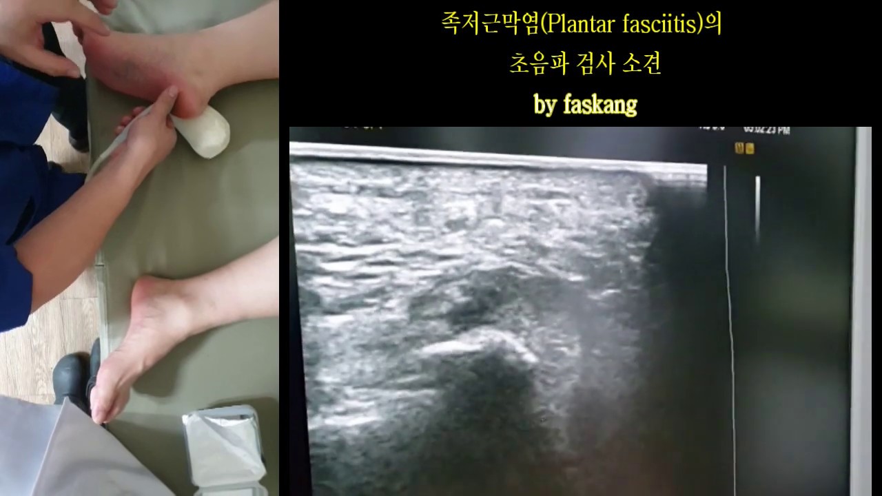 57.(의사용.초음파 검사) 족저근막염(plantar fasciitis) 환자의 초음파 검사 [강찬.충남대.Chan KANG]