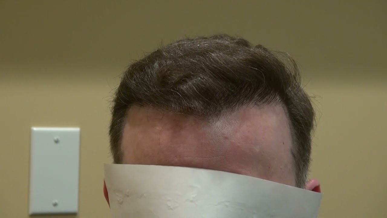 Natural Results of Hair Restoration Treatment for Male Patient