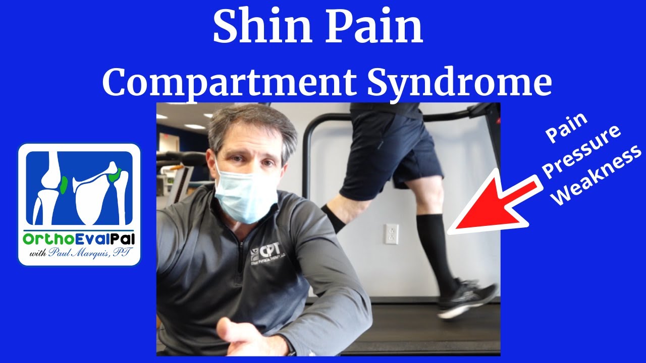 Shin Pain from Compartment Syndrome (Shin pain with running)