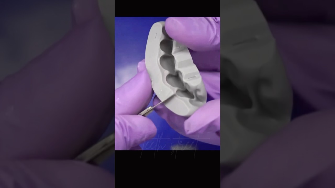 Immediate temporary dental crown