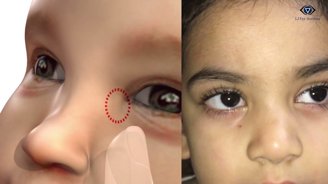 Watery eyes in children: No more!!!