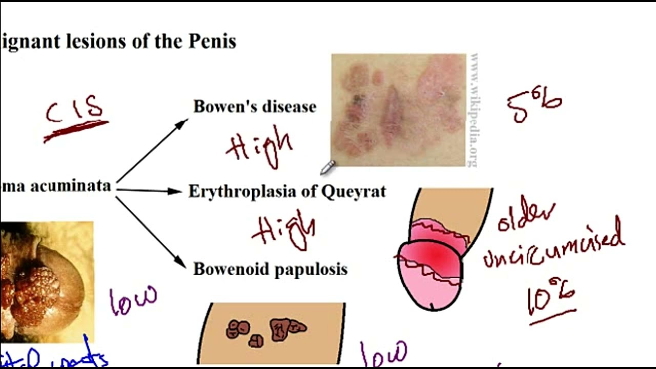 USMLE ACE Video 90: Premalignant lesions of the penis