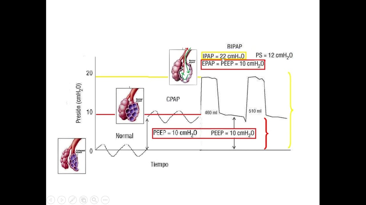 Conceptos básicos en Ventilación Mecánica (no invasiva): visualización (parte 1)