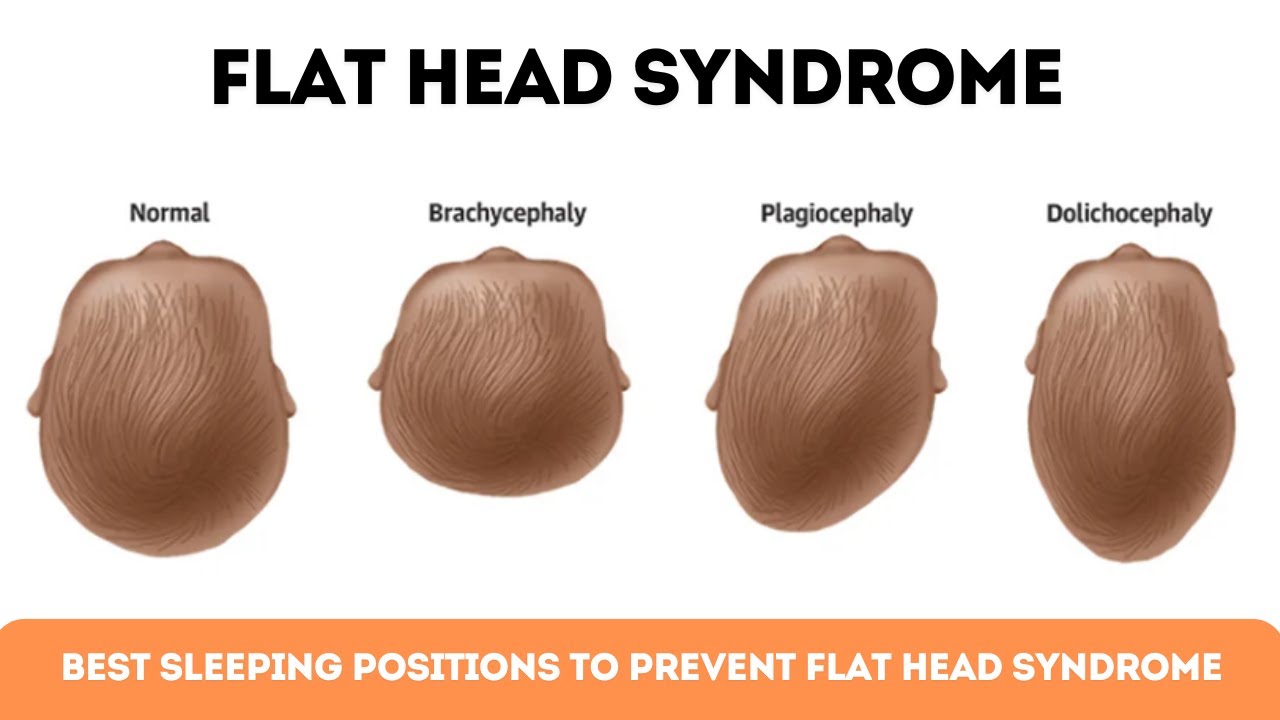 Best Sleeping Positions to Prevent Flat Head Syndrome in Babies