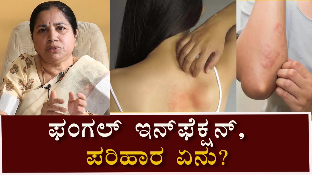 Fungal infections: Symptoms & Treatment | ಫಂಗಲ್ ಇನ್‌ಫೆಕ್ಷನ್ : ಲಕ್ಷಣಗಳು & ಕಾರಣಗಳು | Vijay Karnataka