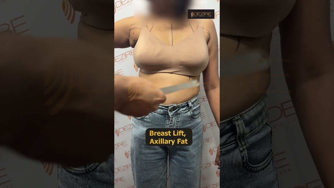 Axillary Fat and Breast Lift Marking