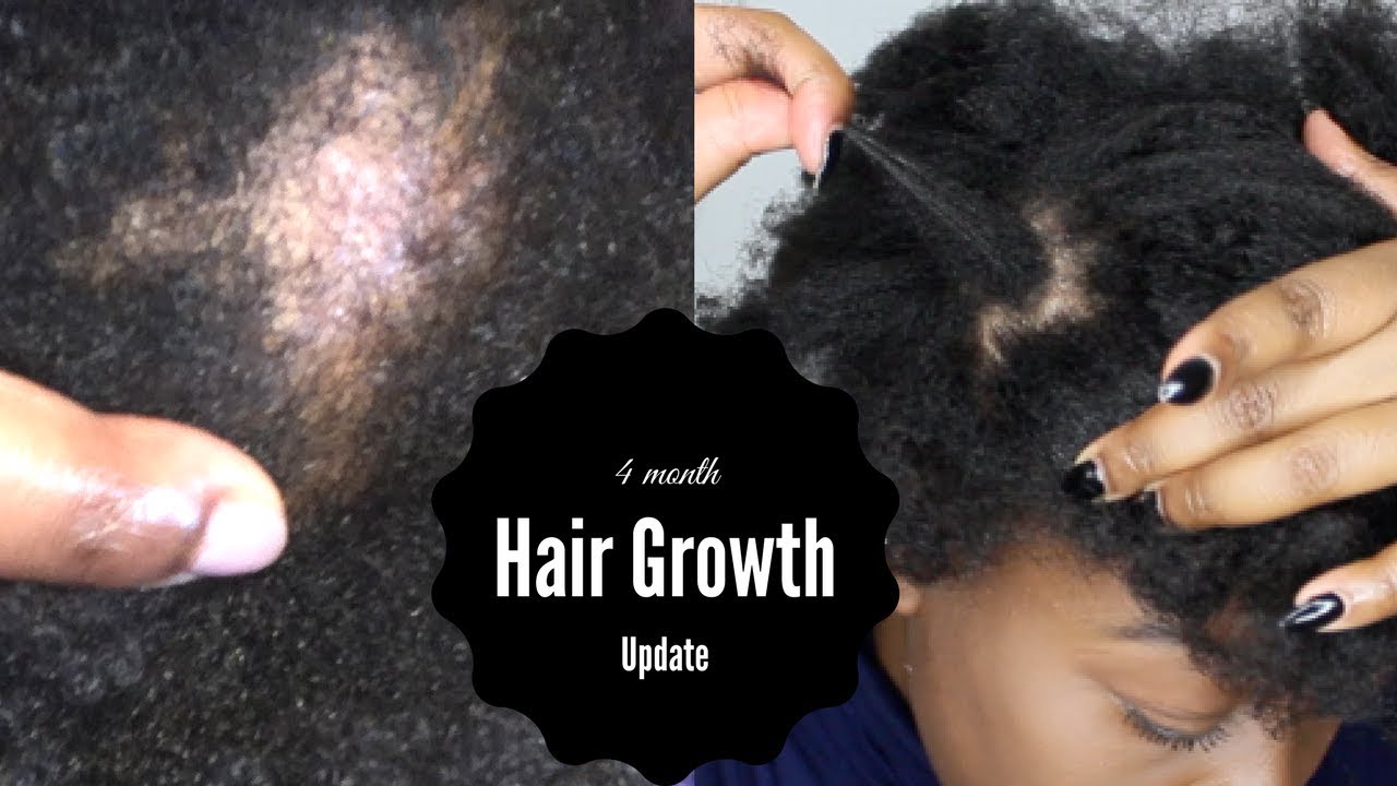 5 Power Tips to Grow Natural Hair | Traction Alopecia