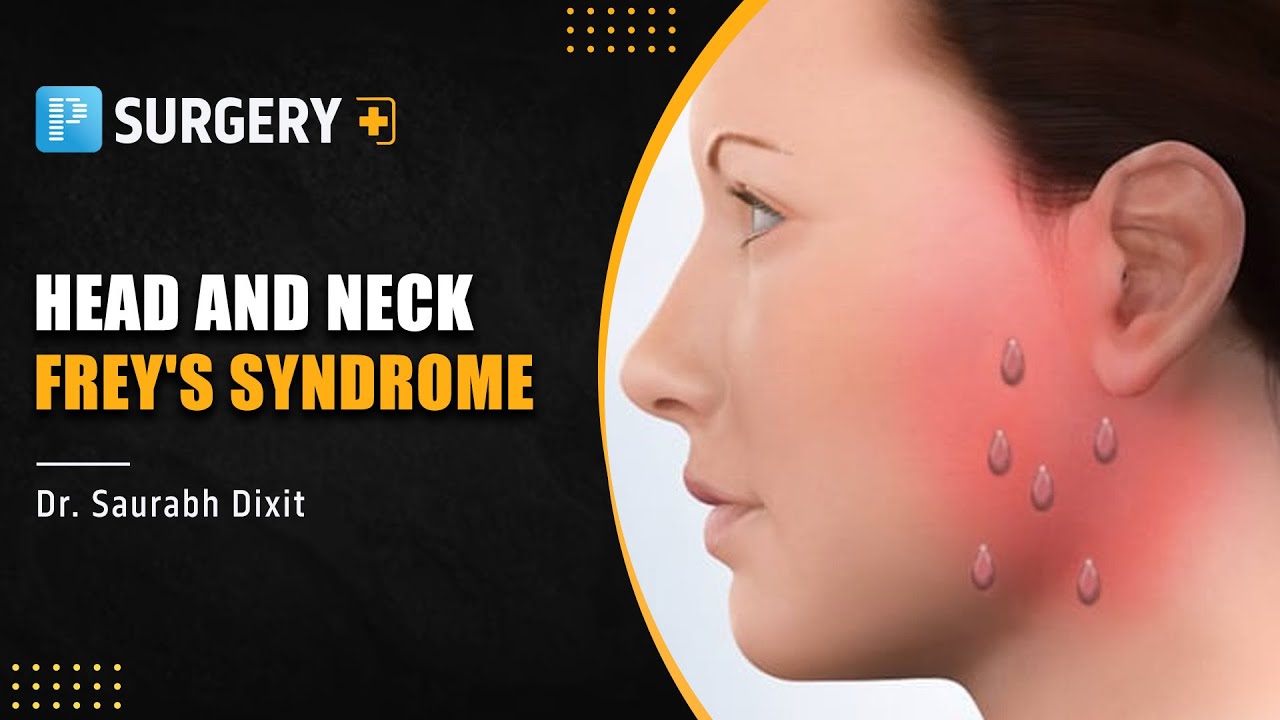Head and Neck - Frey's Syndrome by Dr. Saurabh Dixit - PrepLadder NEET SS