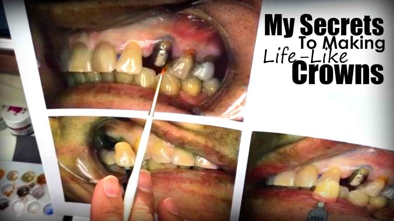 My Secrets to Making Life-Like Crowns the Match Natural Teeth in All Conditions