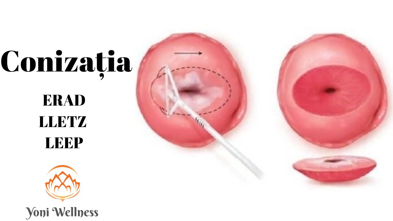 S2. Ep 30 - CONIZAȚIA | ERAD | LLETZ | LEEP | Biopsia de col | HPV | HGSIL | LGSIL | ASC-US