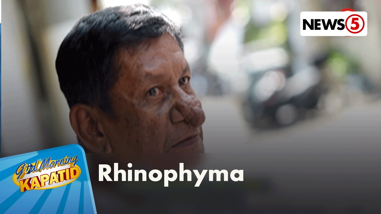 Pangangapal ng ilong o rhinophyma | Gud Morning Kapatid