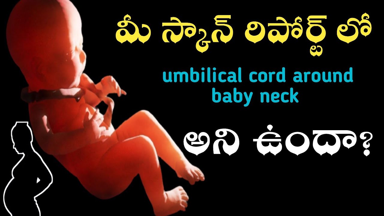 umbilical cord around baby neck telugu