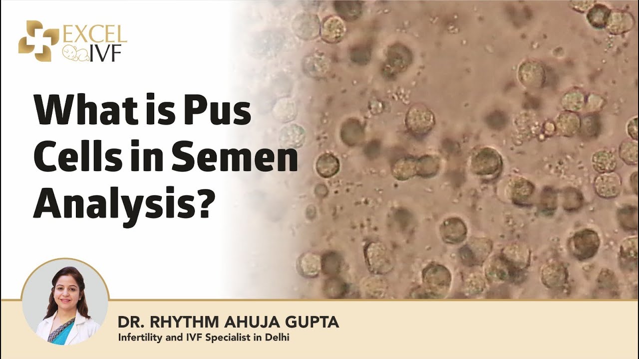 What is Pus Cells in Semen Analysis? Dr Rhythm Gupta - IVF Specialist in Delhi, at Excel IVF