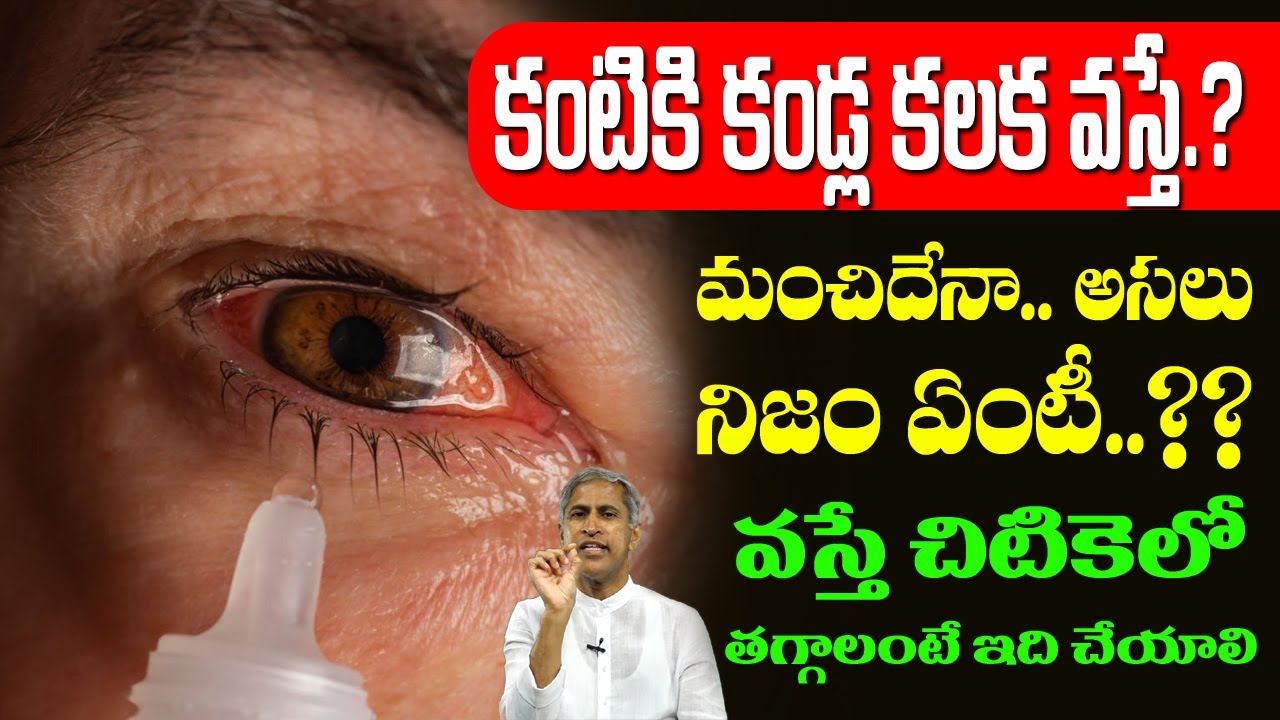 Kalla Kalaka | కంటికి కండ్ల కలక లు వస్తే? మంచిదేనా? ఎలా తగ్గించాలి | Dr Manthena Satyanarayana Raju