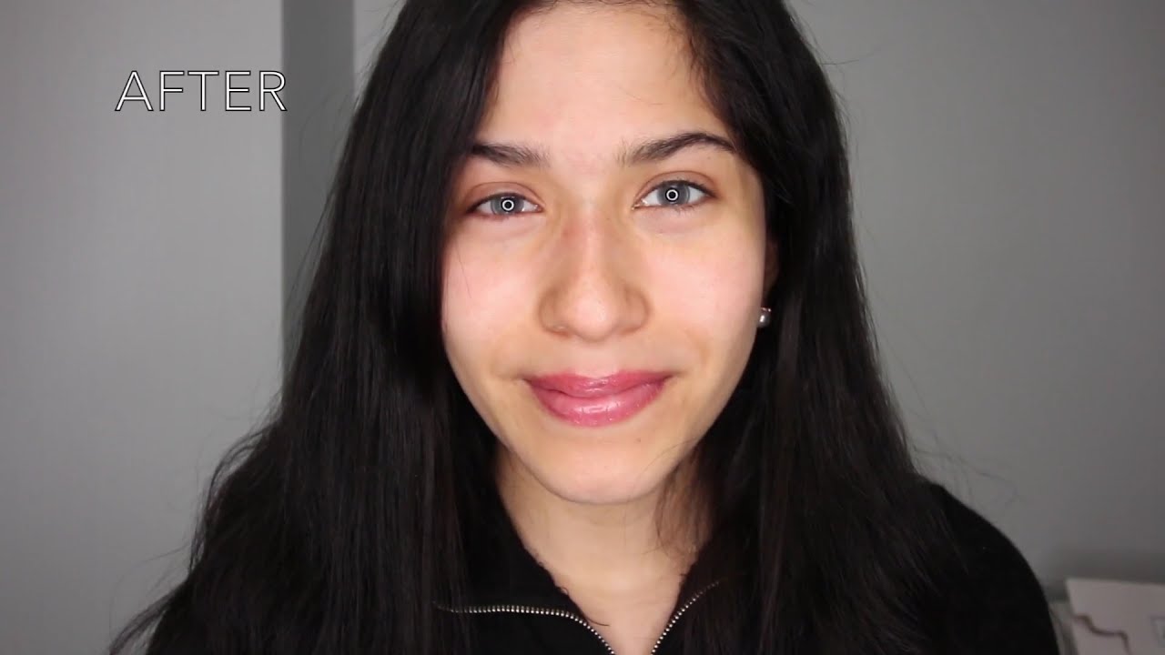 Eye Color Change from Dark Brown to Emerald Green with Kerato