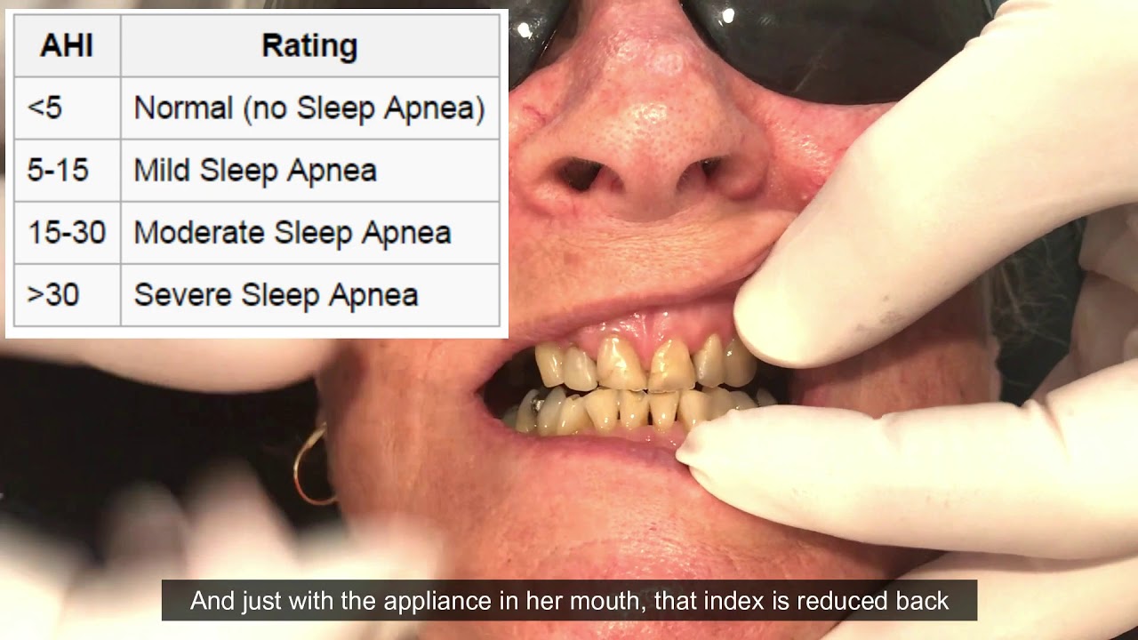 Dead Giveaways of Sleep Apnoea