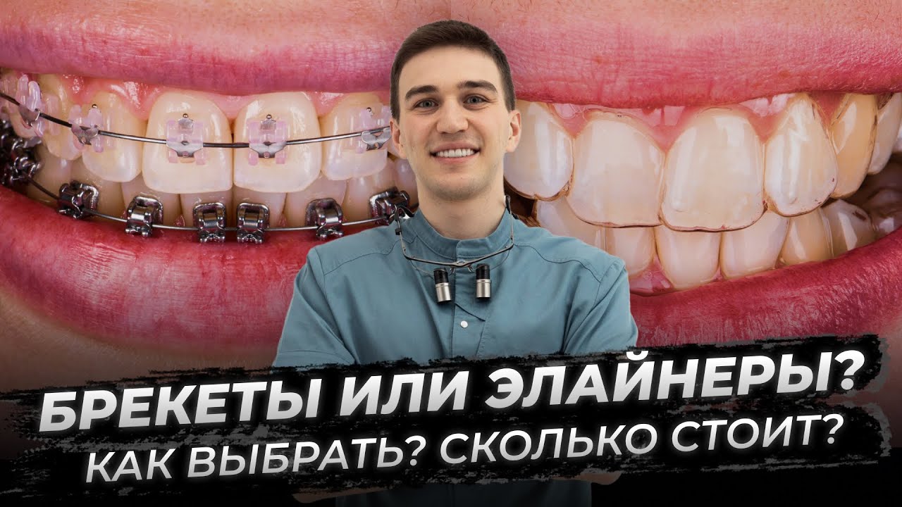 Брекеты или элайнеры: как выбрать, сколько стоит?