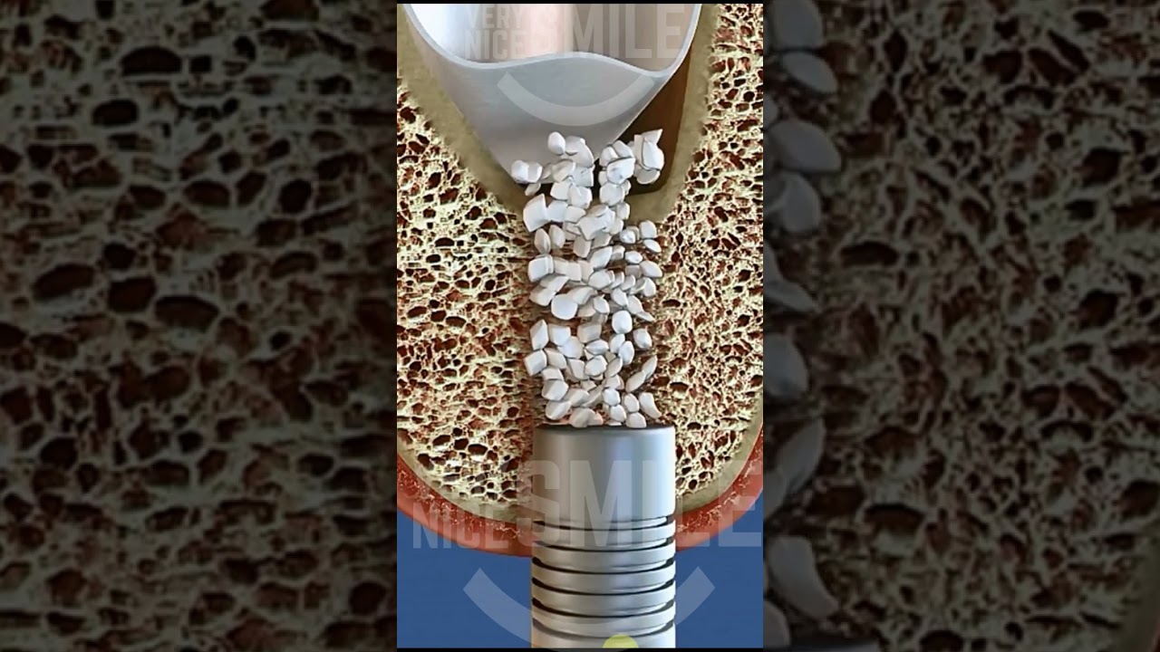 Crestal vs lateral sinus lift #shorts
