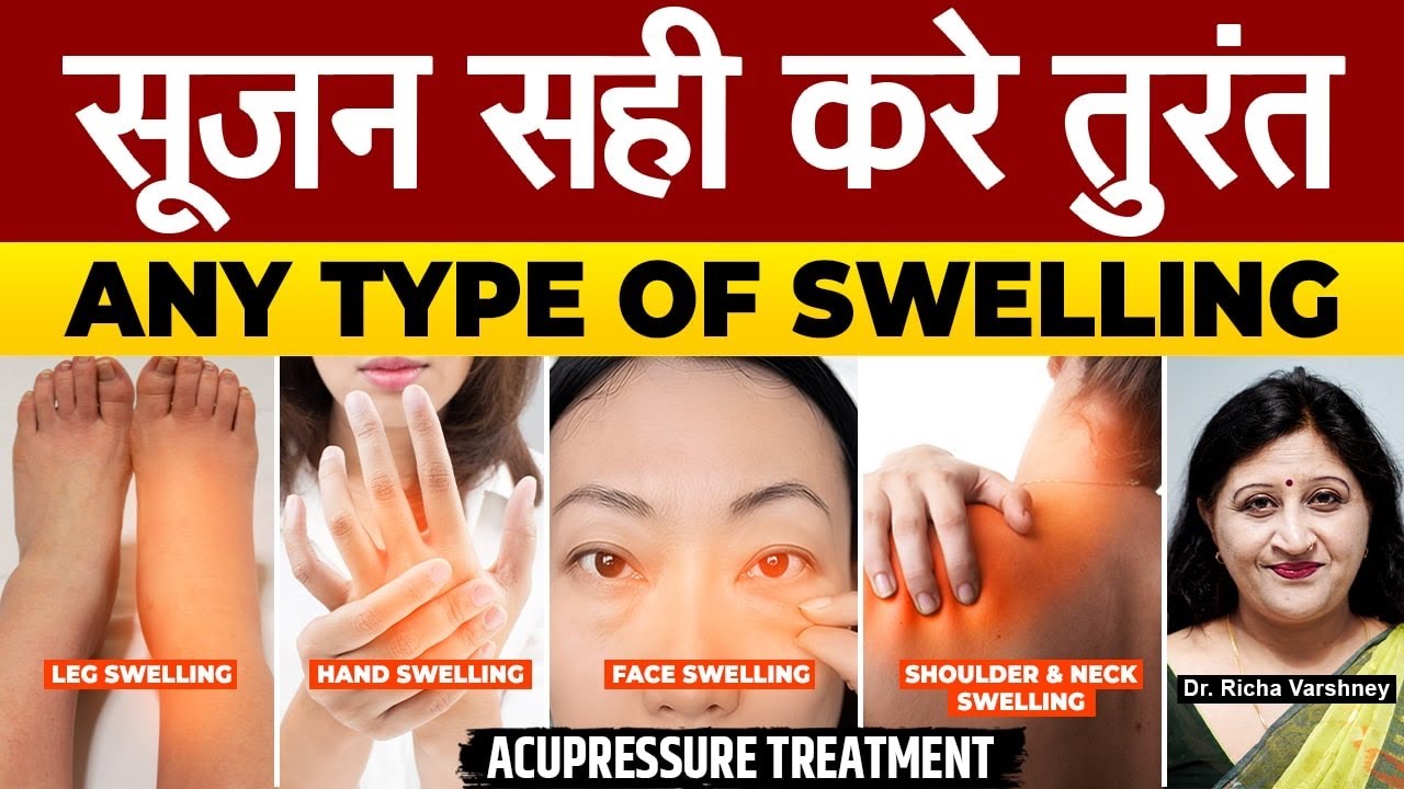 Acupressure Treatment For Swelling In Foot, Eye, Face, Knee, Leg, Ankle [सूजन का इलाज]