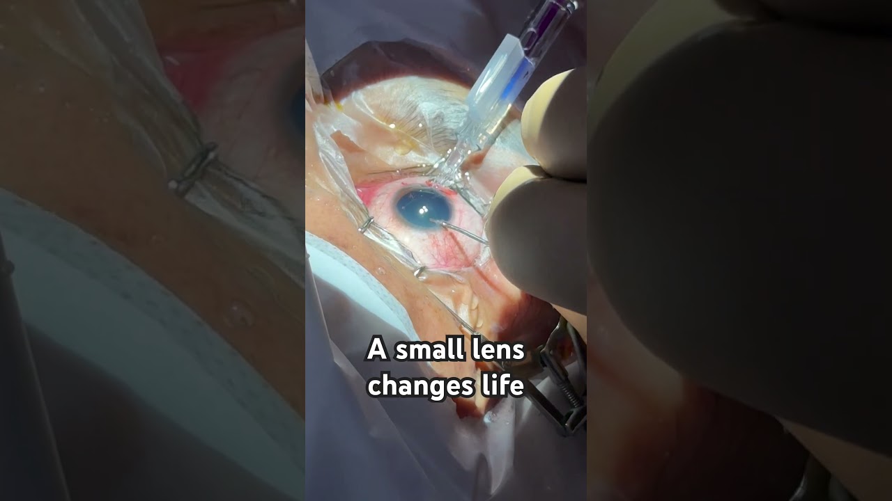 Life changing Phakic IOL #suneyecafe #eyetreatment