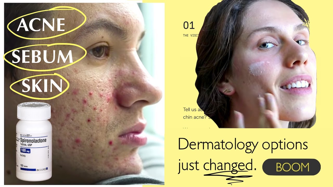 Dermatology Options Just Changed Spironolactone: This Hormonal Acne Rx Is Only Available In 1 Place
