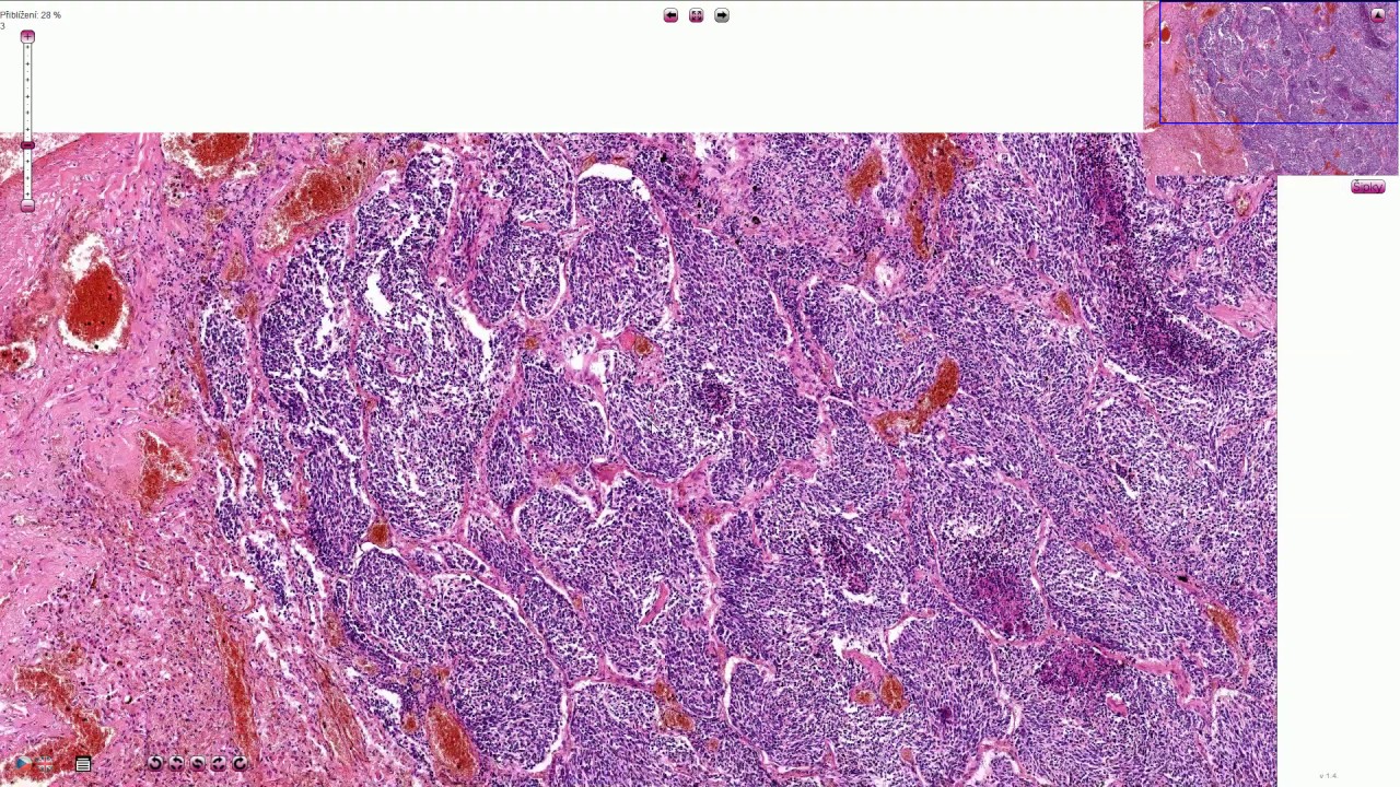 Small Cell Carcinoma of the Lungs - Histopathology