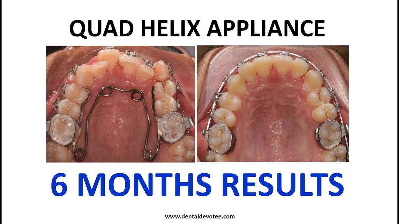 Quad Helix for Arch Expansion - Six Months Result by Quadhelix