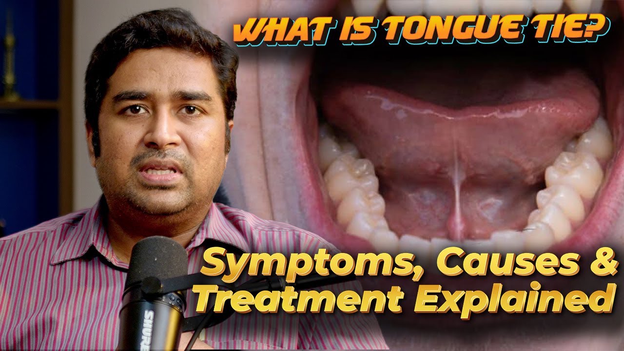 What Is Tongue Tie? Symptoms, Causes & Treatment Explained | Dr Vignesh ENT
