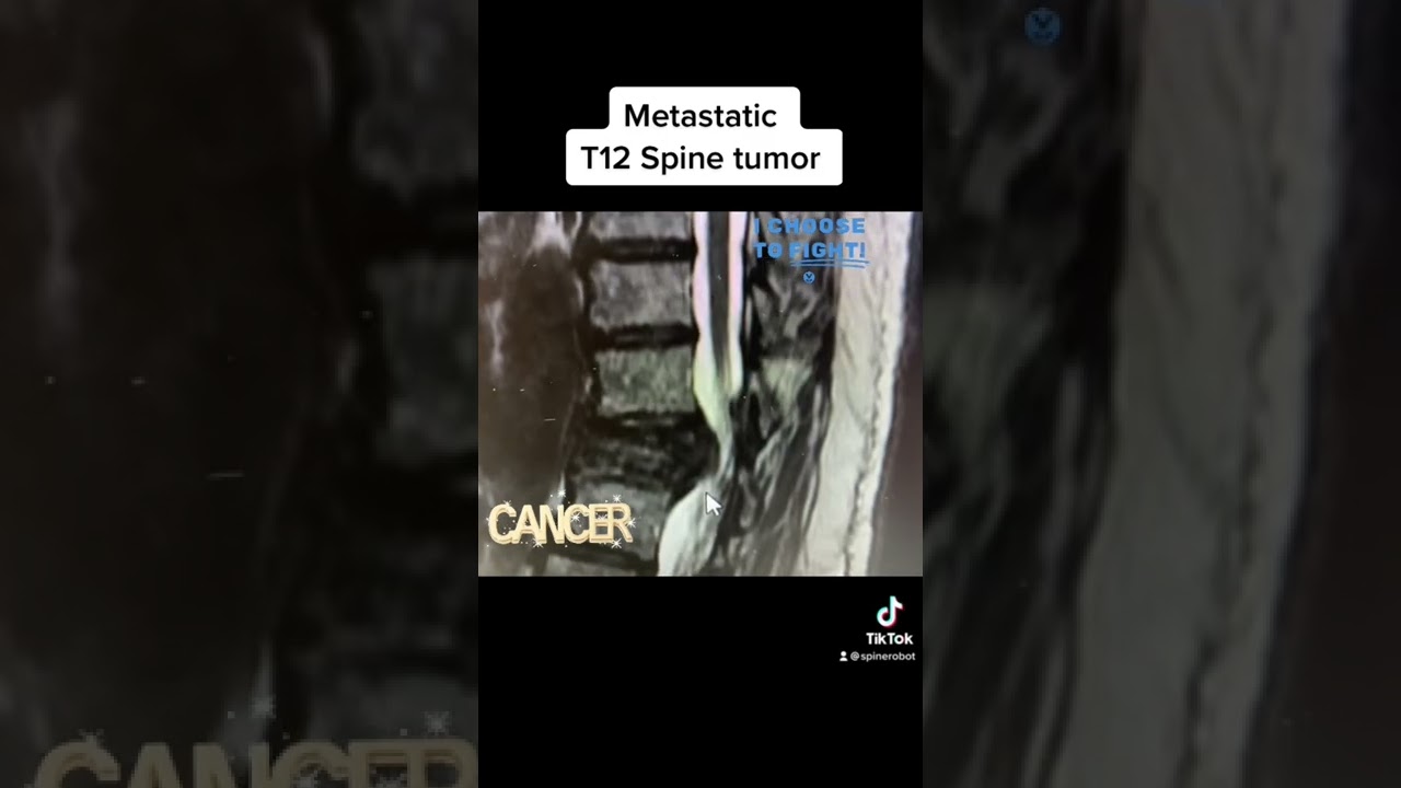 Spine Tumor  #spine #surgery #tumor #cancer #back #backpain #neurosurgeon #health #wellness #doctor