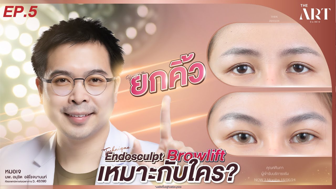 EP5 ยกคิ้วเทคนิค Endosculpt Browlift เหมาะกับใคร