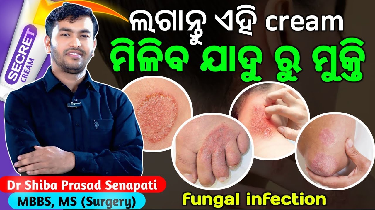 ଯାଦୁ ଭଲହେବ ଲଗାନ୍ତୁ ଏହି କ୍ରିମ୍#fungalinfection#odiahealthtips