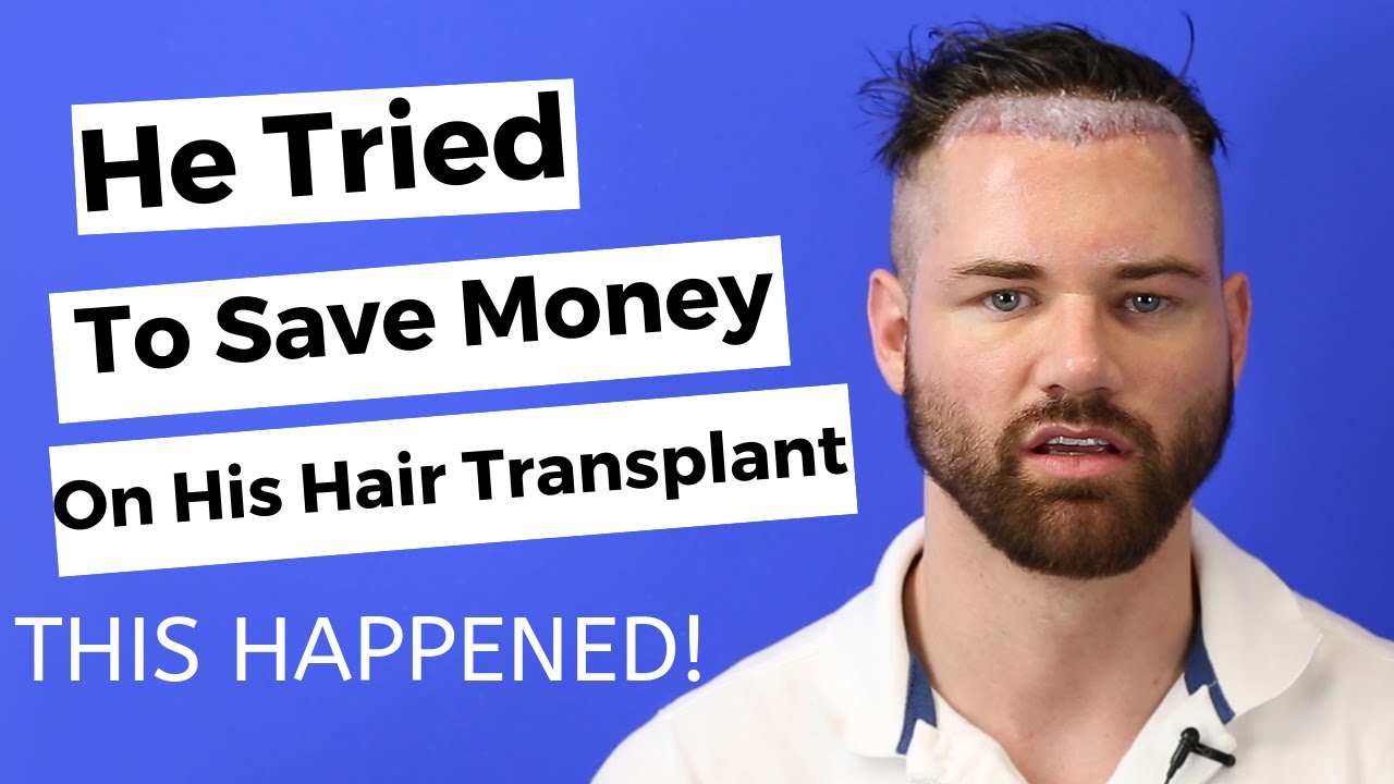 He Had Hair Transplant Surgery In Turkey To Save Money - This Happened