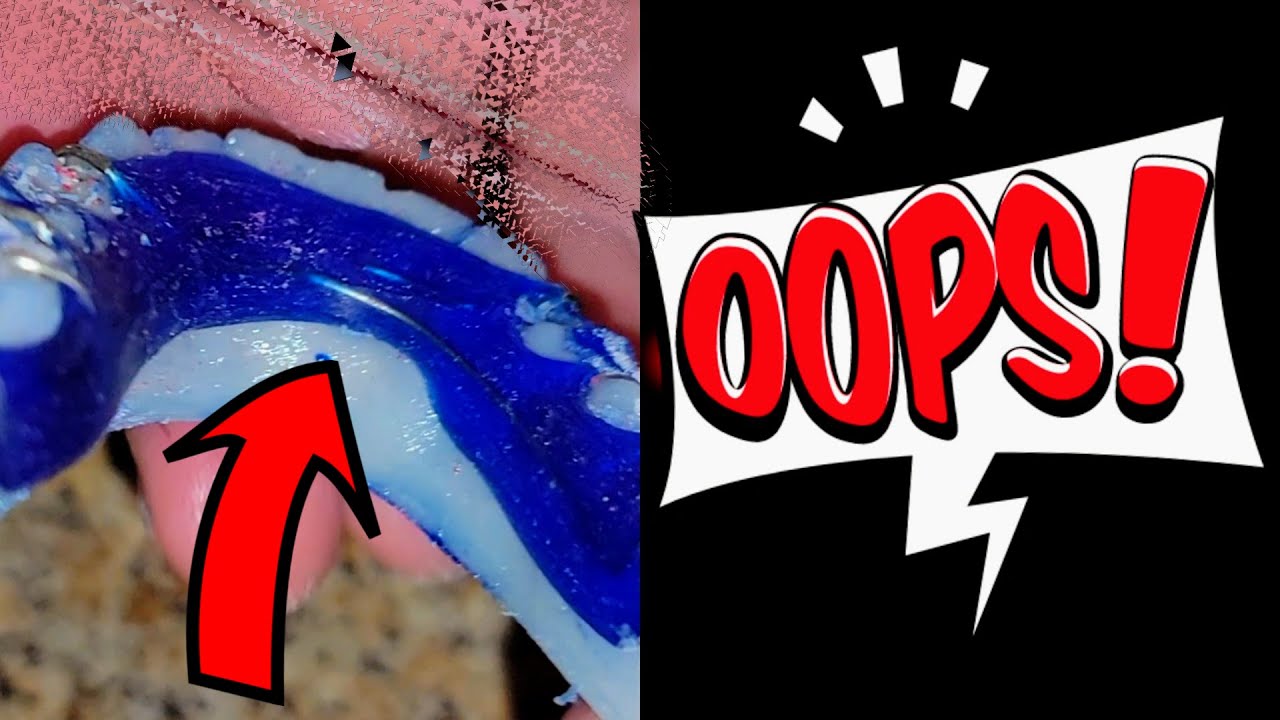 How to Repair Acrylic Retainer Perfect (Secrets Out)