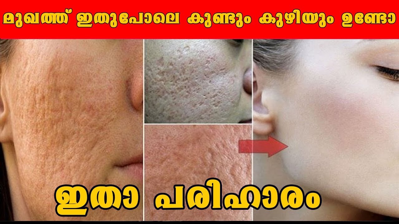 വെറും മൂന്നു പ്രാവശ്യം മുഖത്ത് ഇങ്ങനെ ചെയ്താല്‍ /Easy way to get rid of large open pores on face