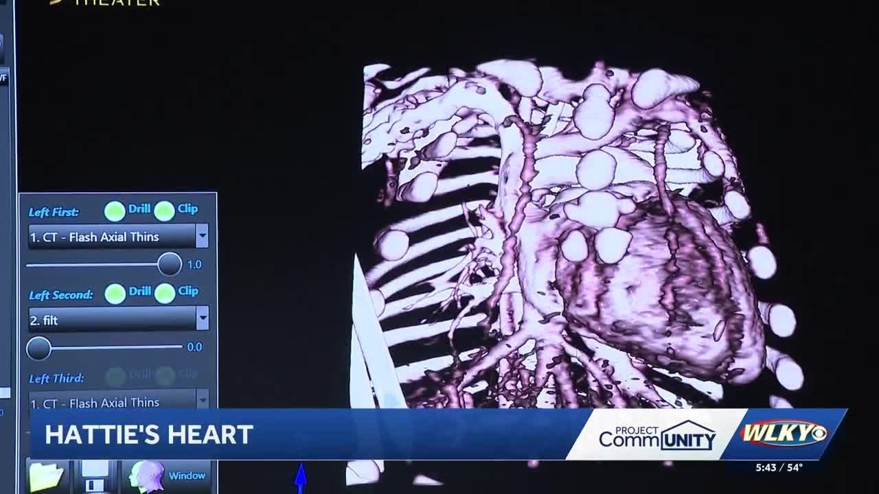 Norton Children's Hospital using groundbreaking technology to repair heart conditions