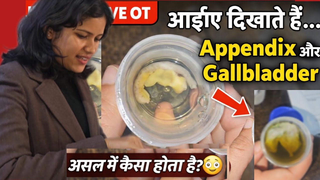 आइए दिखाते हैं Appendix और Gallbladder कैसा होता है 🏥#Day161 #dailyvlog #familyvlog #hospitallife 