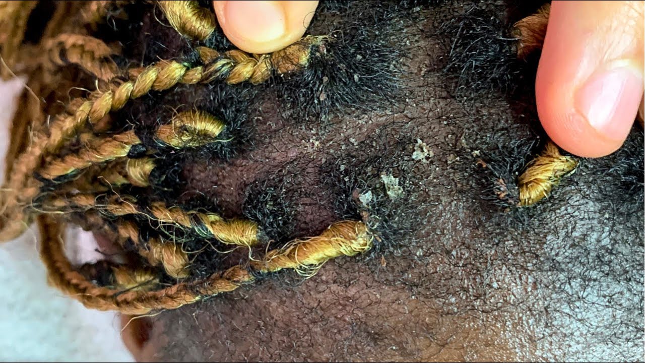 ASMR Scalp Scratching Between Braids, Awwww so satisfying 😴