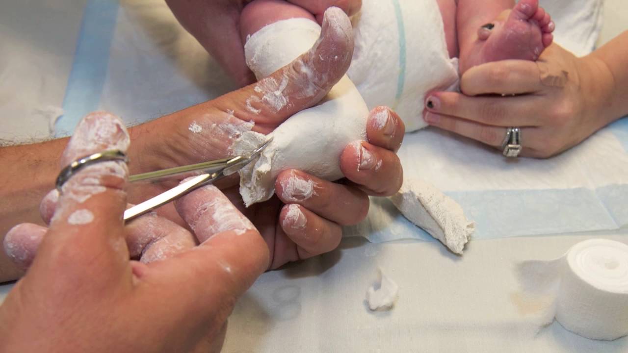 Club Foot - Akron Children's Hospital video